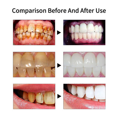 SonicDazz™ – Détartreur Dentaire Ultrason pour un Sourire Éclatant